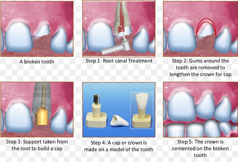 Crown Root Canal Cracked Tooth Syndrome Human Tooth, PNG, 1584x1076px, Crown, Abutment, Advertising, Brand, Cracked Tooth Syndrome Download Free