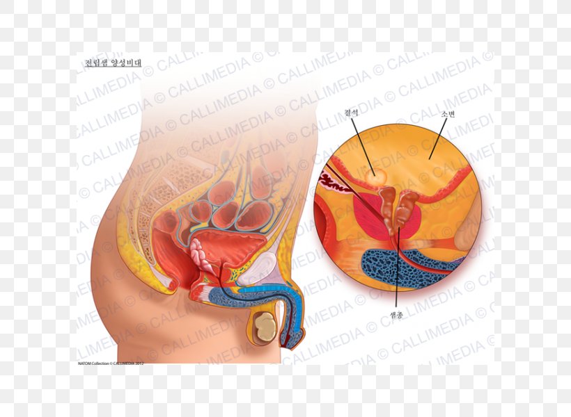 Prostate Genitourinary System Benign Prostatic Hyperplasia Urinary Bladder Urology, PNG, 600x600px, Watercolor, Cartoon, Flower, Frame, Heart Download Free