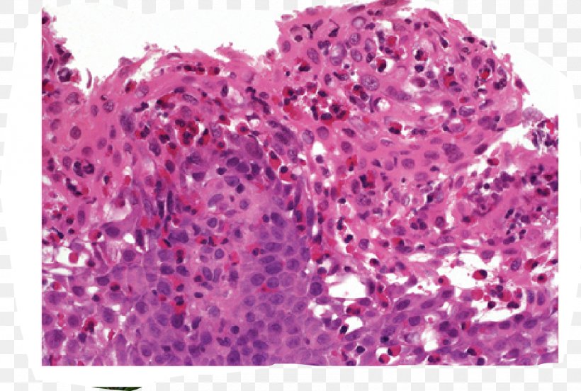 Eosinophilic Esophagitis Esophagus Dysphagia, PNG, 1700x1146px, Eosinophilic Esophagitis, Biopsy, Dysphagia, Eosinofiel, Eosinophil Download Free