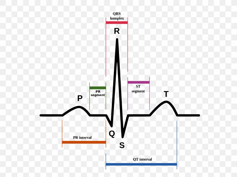 Electrocardiography Heart Sinus Rhythm QRS Complex Cardiac Arrest, PNG, 1280x960px, Electrocardiography, Area, Atrium, Brand, Cardiac Arrest Download Free