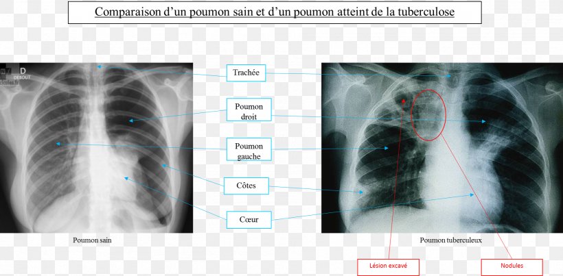 Tuberculosis Radiology Lung Medicine Infectious Disease, PNG, 1898x933px, Tuberculosis, Disease, Infection, Infectious Disease, Jaw Download Free
