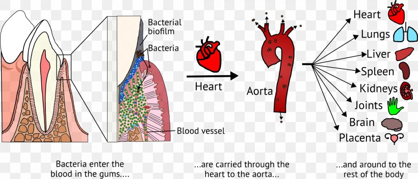 Dental Plaque Systemic Disease Periodontal Disease Bacteria, PNG, 2178x936px, Dental Plaque, Bacteria, Biofilm, Disease, Gums Download Free