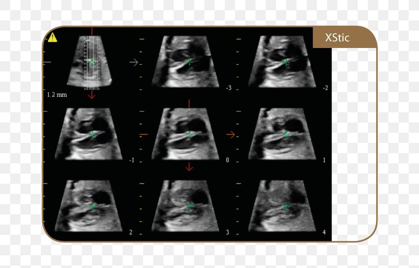 Ultrasonography TWICE Medical Equipment Medicine Magnetic Resonance Imaging, PNG, 700x525px, Ultrasonography, Academisch Ziekenhuis, Brand, Camera, High Tech Download Free