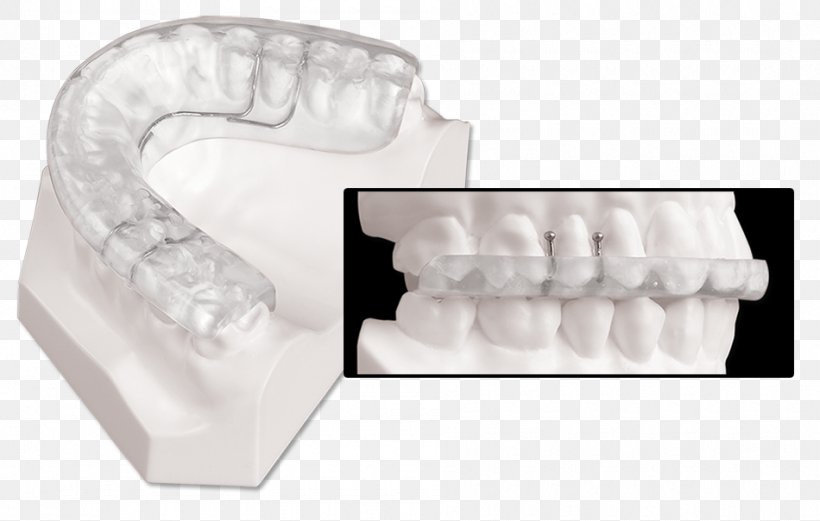 Splint Jaw Maxilla Dentistry Temporomandibular Joint Dysfunction, PNG, 950x604px, Splint, Articulator, Atypical Facial Pain, Dentistry, Jaw Download Free