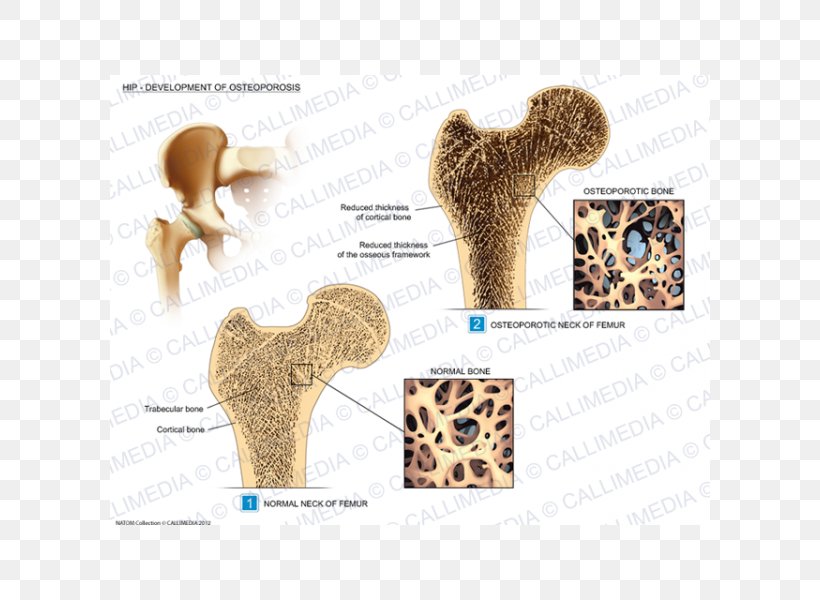 Hip Osteoporosis Rheumatology Osteoarthritis Illustration Anatomique, PNG, 600x600px, Hip, Acetabulum, Anatomy, Banco De Imagens, Bone Fracture Download Free