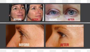 Skin Rosacea Hyperpigmentation Wrinkle Forehead PNG