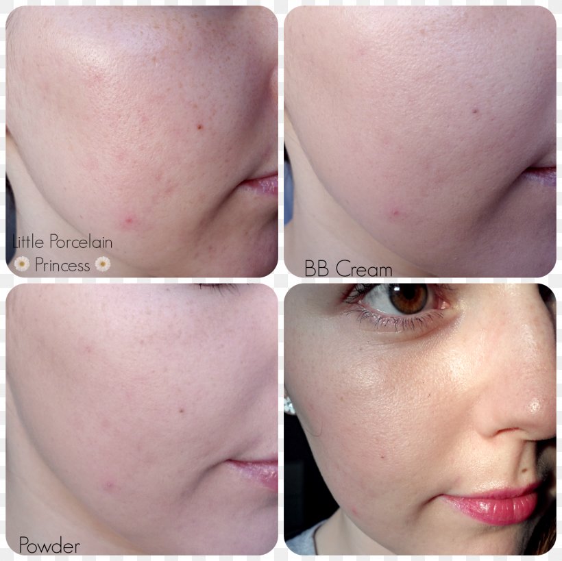 Skin Food Scar BB Cream Cheek, PNG, 1600x1600px, Skin Food, Acne, Bb Cream, Cheek, Chin Download Free