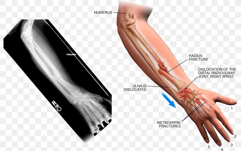 Thumb Arm Sprain X-ray, PNG, 2028x1267px, Thumb, Arm, Bone Fracture, Carpal Bones, Finger Download Free