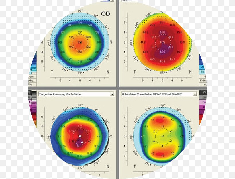 Cataract Corneal Topography Eye Examination, PNG, 625x625px, Cataract, Area, Autorefractor, Cataract Surgery, Cornea Download Free