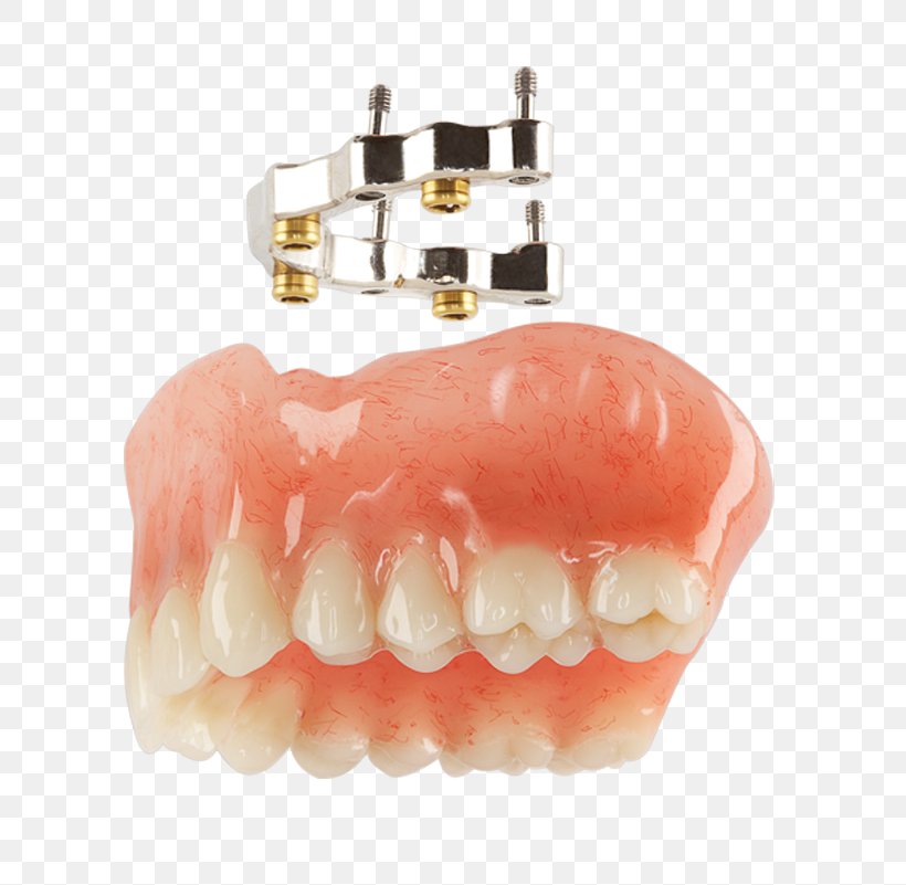 Overdentures Tooth Dental Implant Implant Bars, PNG, 731x801px, Tooth, Dental Crafters Inc, Dental Implant, Dental Laboratory, Dentist Download Free