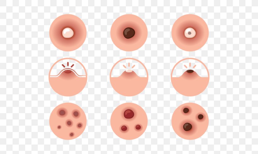 Propionibacterium Acnes Anxiety Nose Cheek, PNG, 700x490px, Acne, Animaatio, Animation, Anxiety, Button Download Free