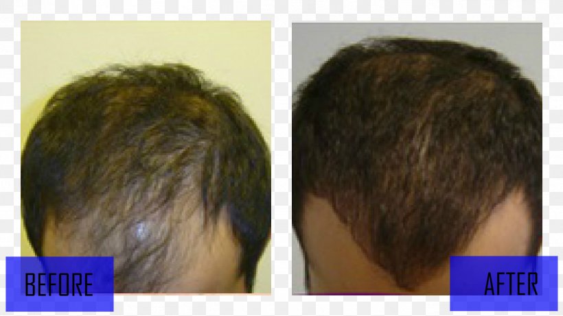 Hair Transplantation Hair Loss Wig Black Hair, PNG, 1366x768px, Hair Transplantation, Black Hair, Brown Hair, Chatham County Georgia, Chin Download Free