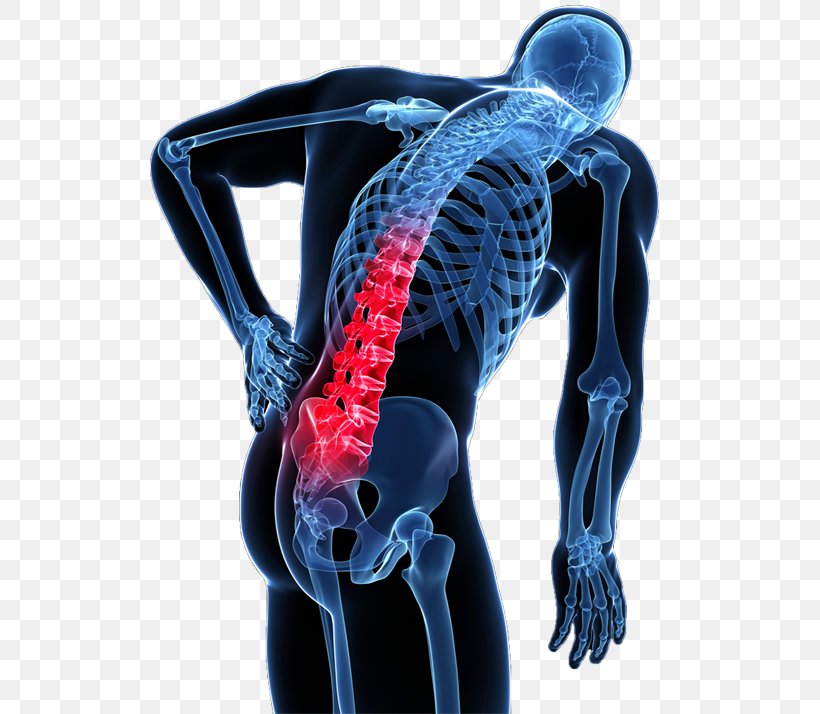 Low Back Pain Human Back Vertebral Column, PNG, 531x714px, Back Pain, Arthritis, Chiropractic, Disease, Electric Blue Download Free