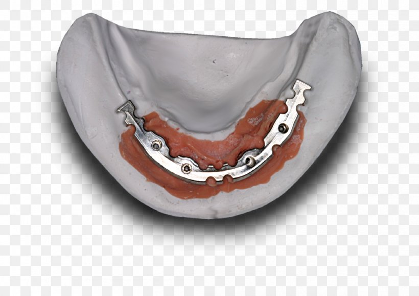 Jaw Dental Implant Dental Laboratory Dentistry Dentures, PNG, 1052x744px, Jaw, Abutment, Bremadent Dental Laboratory, Cadcam Dentistry, Dental Implant Download Free