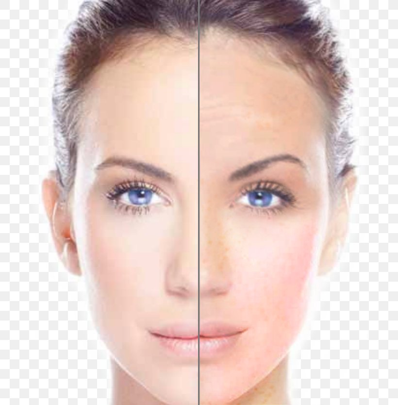 Radio Frequency Skin Tightening Skin Care Photorejuvenation Chemical Peel, PNG, 700x834px, Radio Frequency Skin Tightening, Acne, Beauty, Cheek, Chemical Peel Download Free