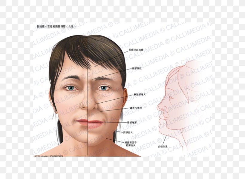 Acromegaly Gigantism Face Symptom Growth Hormone, PNG, 600x600px, Watercolor, Cartoon, Flower, Frame, Heart Download Free