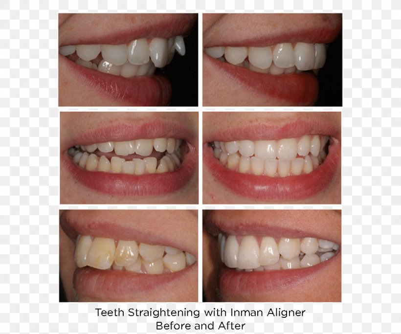 Tooth Adult Orthodontics Clear Aligners Dental Braces, PNG, 960x800px, Tooth, Clear Aligners, Cosmetic Dentistry, Dental Braces, Dentist Download Free