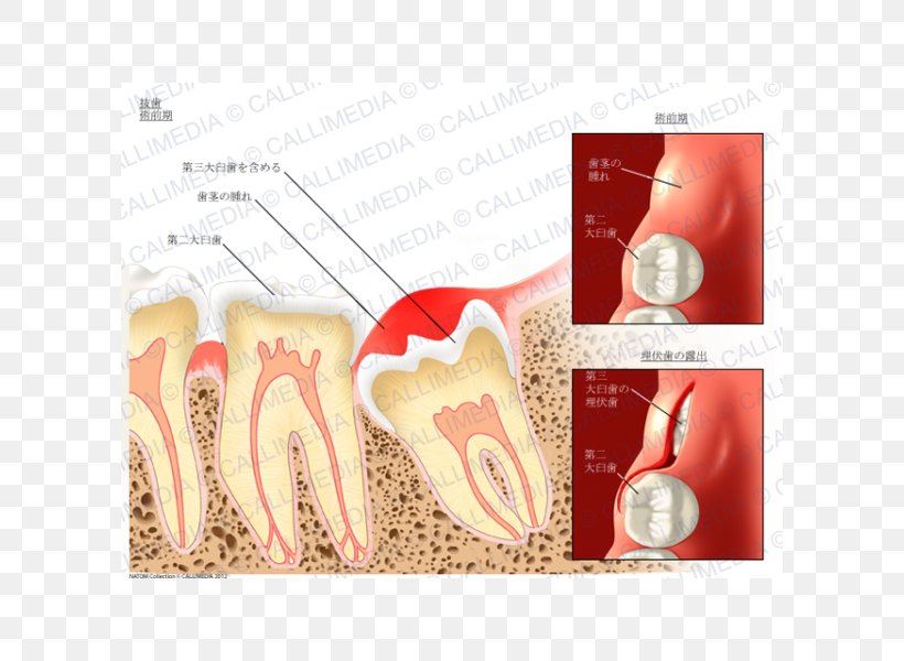 Dental Extraction Tooth Dentistry Molar, PNG, 600x600px, Dental Extraction, Canine Tooth, Dentist, Dentistry, Extraction Download Free