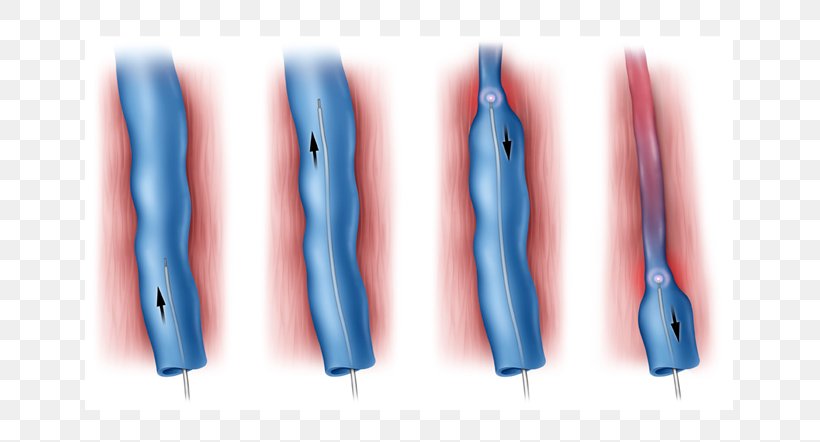 Endovenous Laser Treatment Varicose Veins Surgery, PNG, 651x442px, Endovenous Laser Treatment, Arm, Blood, Blue, Compression Stockings Download Free