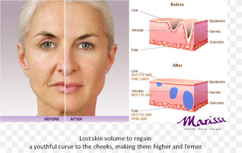 Injectable Filler Juvéderm Timeless Aesthetics MedSpa Hyaluronic Acid Cost, PNG, 890x564px, Injectable Filler, Cheek, Chin, Cost, Ear Download Free