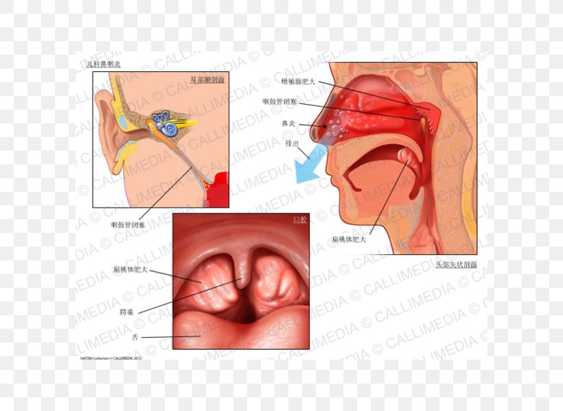 Adenoid Hypertrophy Tonsillitis Infection, PNG, 600x600px, Watercolor, Cartoon, Flower, Frame, Heart Download Free