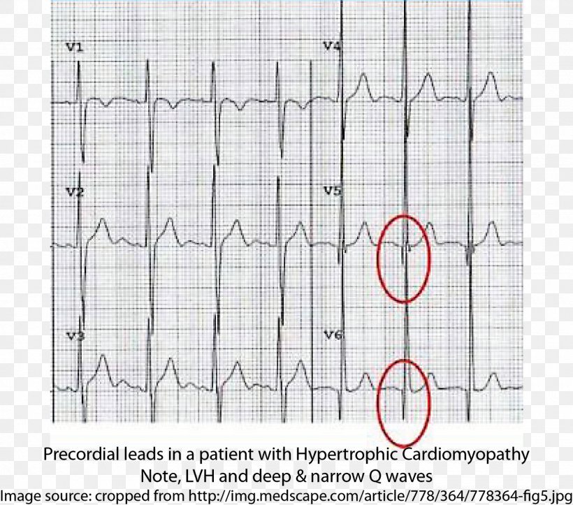 Hypertrophic Cardiomyopathy Electrocardiography Syncope Cardiac Arrest, PNG, 1600x1412px, Hypertrophic Cardiomyopathy, Area, Cardiac Arrest, Cardiology, Cardiomyopathy Download Free
