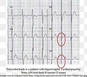 Restrictive Cardiomyopathy Dilated Cardiomyopathy Hypertrophic ...