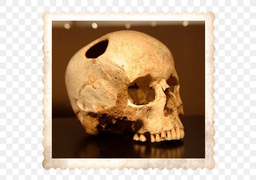 Trepanning Medicine Surgery Disease Cure, PNG, 768x576px, Trepanning, Ancient Technology, Augers, Bone, Brain Download Free