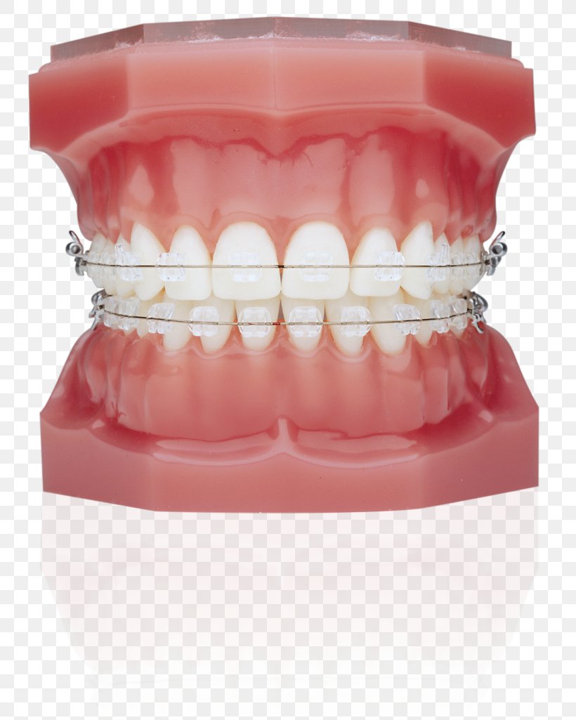 Dental Braces Orthodontics Clear Aligners Lingual Braces Dentistry, PNG, 812x1025px, Dental Braces, Child, Clear Aligners, Dental Bonding, Dentist Download Free