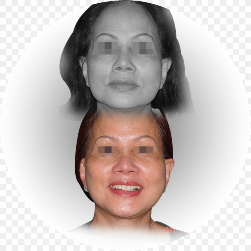 Cheek Eye Light Rhytidectomy Forehead, PNG, 900x900px, Cheek, Ageing, Child, Chin, Ear Download Free