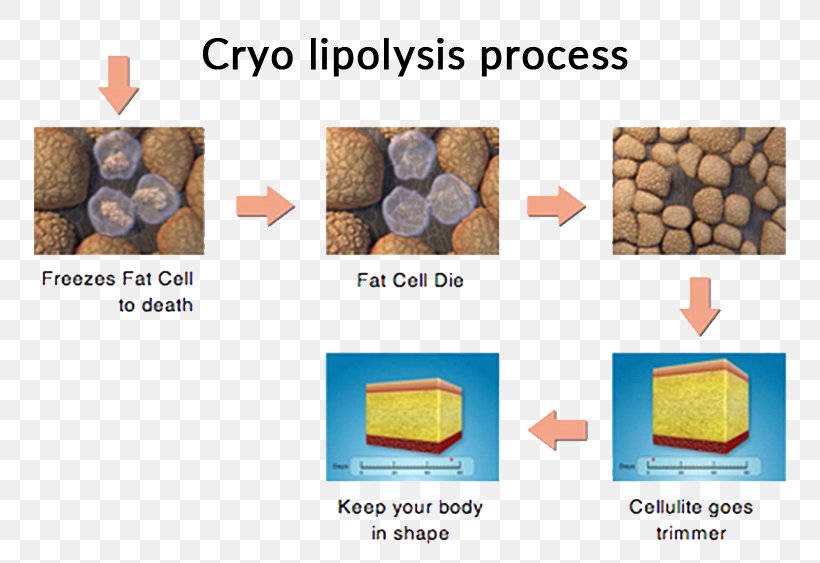 Cryolipolysis Liposuction Adipose Tissue Cellulite, PNG, 800x563px, Cryolipolysis, Abdominal Obesity, Adipocyte, Adipose Tissue, Cellulite Download Free