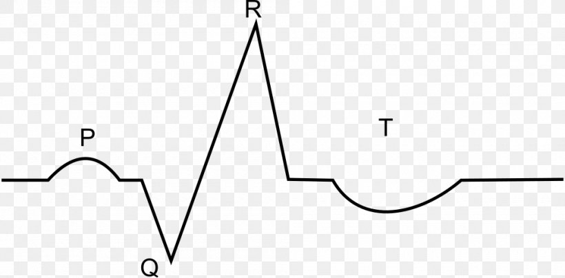 Myocardial Infarction Electrocardiography Heart Clip Art, PNG, 1000x493px, Myocardial Infarction, Area, Black And White, Cardiology, Diagram Download Free