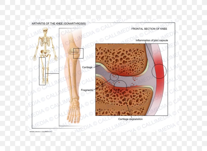 Shoulder Knee Osteoarthritis Knee Arthritis, PNG, 600x600px, Watercolor, Cartoon, Flower, Frame, Heart Download Free