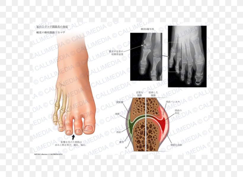 Nail Arthritic Pain Rheumatoid Arthritis Foot Joint, PNG, 600x600px, Watercolor, Cartoon, Flower, Frame, Heart Download Free