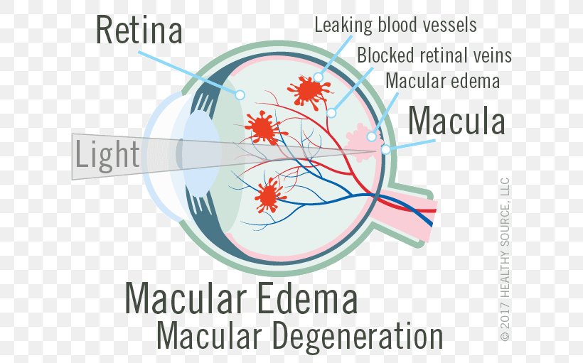 Macula Of Retina Macular Edema Central Retinal Vein Occlusion, PNG, 640x511px, Watercolor, Cartoon, Flower, Frame, Heart Download Free