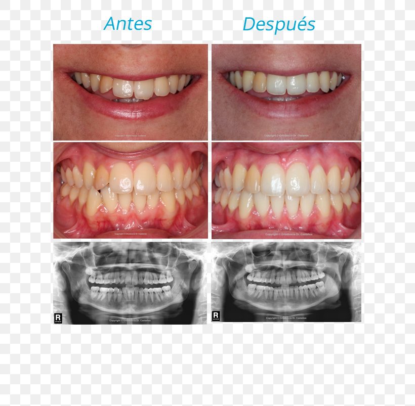 Tooth Orthodontics Malocclusion Dr. Castaños Ortodoncia Incisor, PNG, 609x803px, Tooth, Bilbao, Cosmetic Dentistry, Elasticity, Incisor Download Free