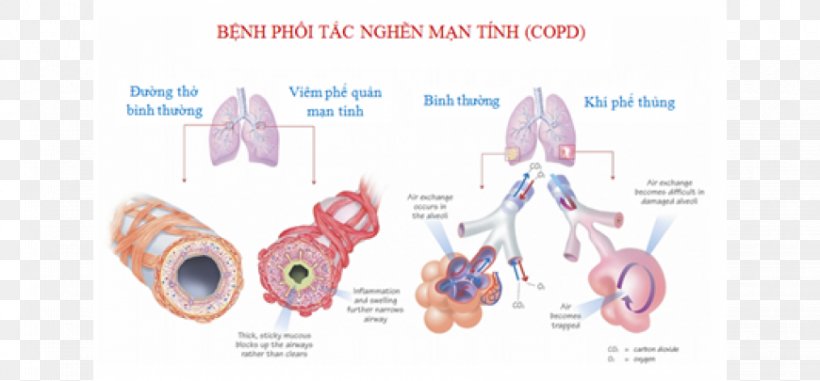 Chronic Obstructive Pulmonary Disease Bronchitis Obstructive Lung Disease, PNG, 870x405px, Watercolor, Cartoon, Flower, Frame, Heart Download Free