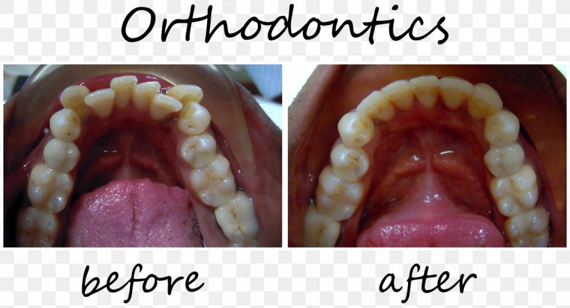 Orthodontics Dentistry Veneer Smiles Of Cary The Lumineers, PNG, 1200x651px, Orthodontics, Cary, Dentistry, Jaw, Lip Download Free