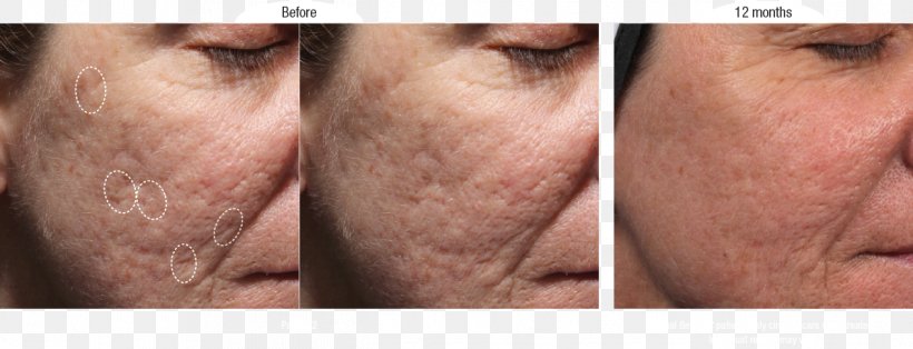 Scar Injectable Filler Acne Wrinkle Artefill, PNG, 1264x485px, Scar, Acne, Artefill, Cheek, Chin Download Free