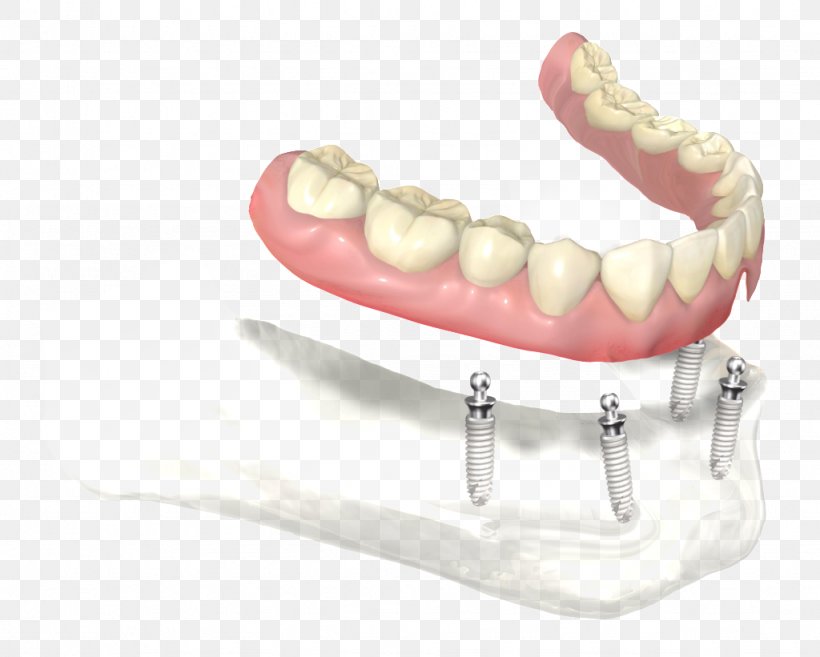 Dentures Dental Implant Dentistry Prosthesis Abutment, PNG, 1024x821px, Dentures, Abutment, Clinic, Cosmetic Dentistry, Dental Implant Download Free