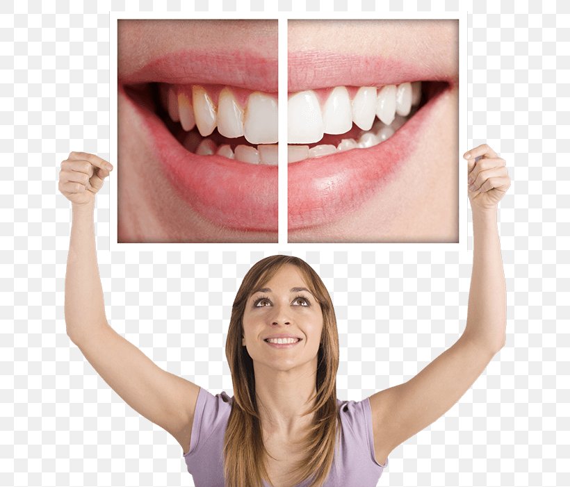 Tooth Whitening Dentistry Human Tooth, PNG, 651x701px, Tooth Whitening, Bridge, Cadcam Dentistry, Chin, Color Download Free