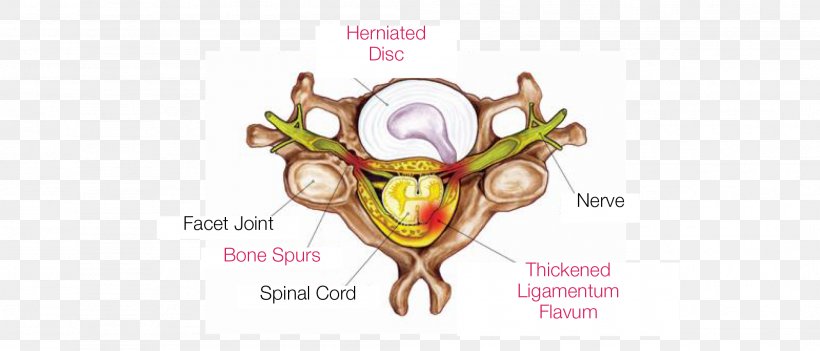 Neck Pain Radiculopathy Nerve Compression Syndrome Vertebral Column Cervical Vertebrae, PNG, 2101x901px, Watercolor, Cartoon, Flower, Frame, Heart Download Free