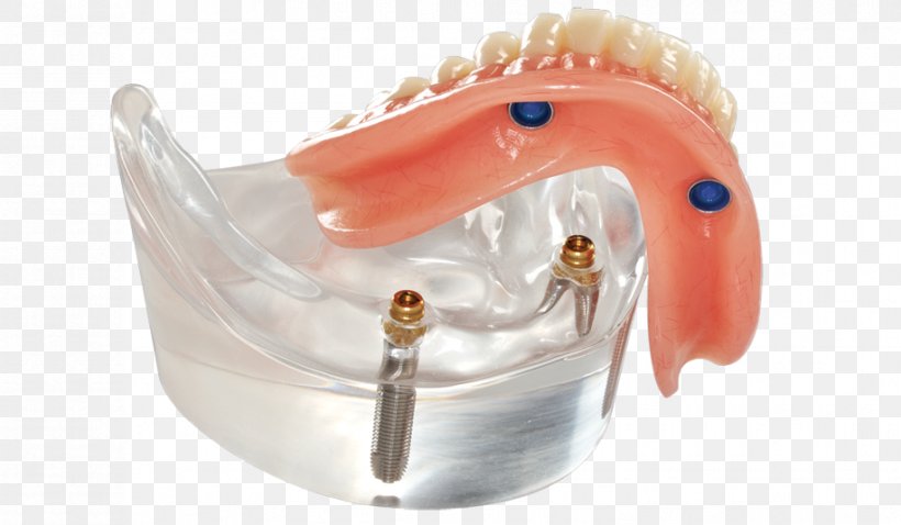 Dentures Dental Implant Dentistry Removable Partial Denture All-on-4, PNG, 916x534px, Dentures, Bridge, Clinic, Cosmetic Dentistry, Dental Implant Download Free