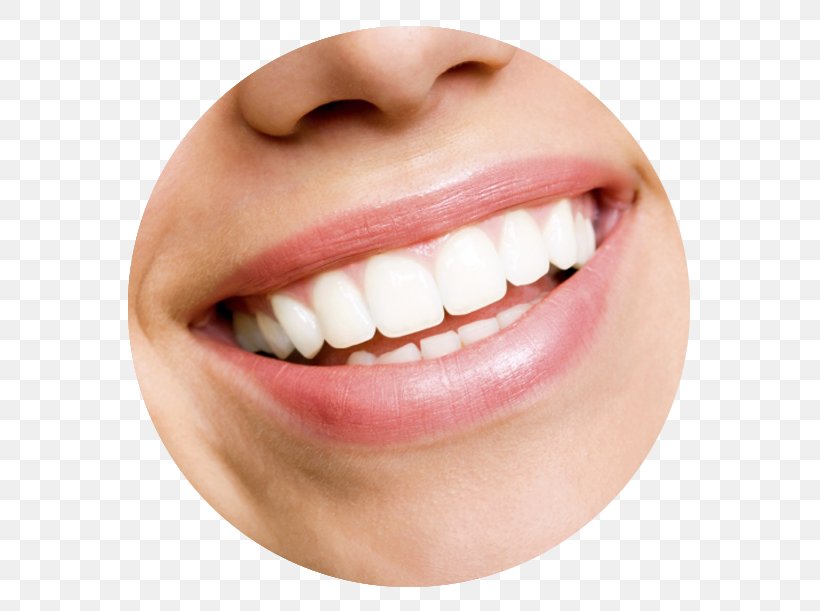 Tooth Whitening Cosmetic Dentistry Human Tooth, PNG, 586x611px, Tooth Whitening, Bridge, Chin, Close Up, Cosmetic Dentistry Download Free