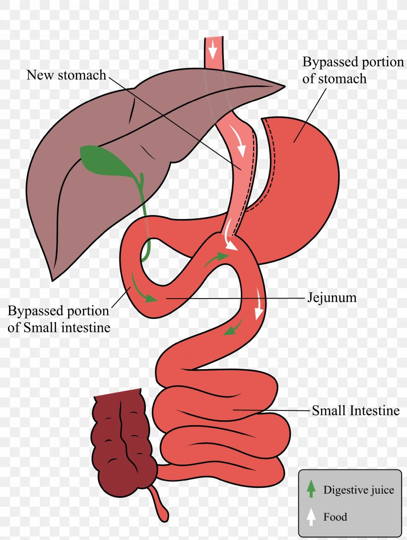 Sleeve Gastrectomy Gastric Bypass Surgery Duodenal Switch Bariatric Surgery, PNG, 3017x4000px, Watercolor, Cartoon, Flower, Frame, Heart Download Free