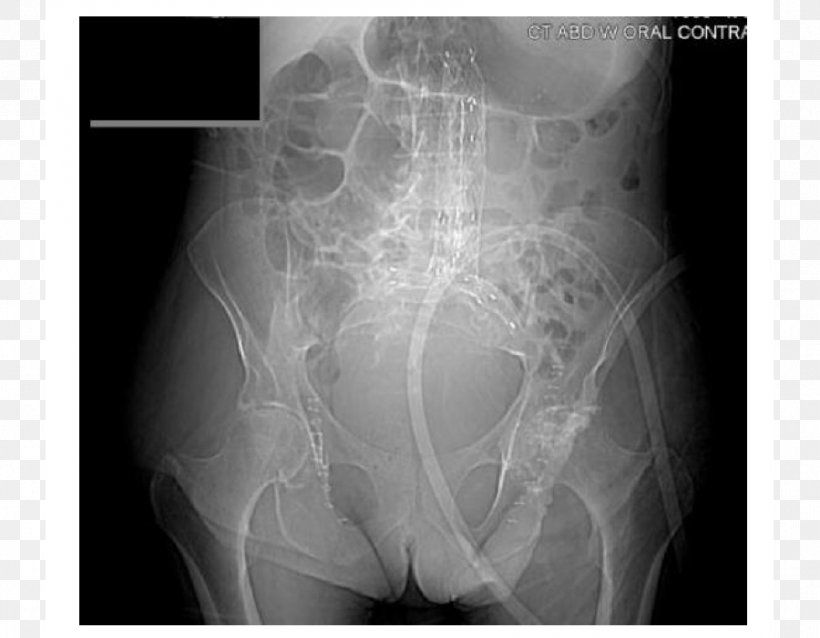 Abdominal Aortic Aneurysm Endovascular Aneurysm Repair Abdomen Surgery, PNG, 900x701px, Abdominal Aortic Aneurysm, Abdomen, Aneurysm, Aorta, Aortic Aneurysm Download Free