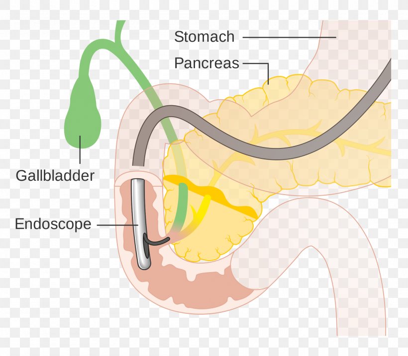 Endoscopic Retrograde Cholangiopancreatography Cholangiography Endoscopy Bile Duct Medical Procedure, PNG, 2000x1749px, Watercolor, Cartoon, Flower, Frame, Heart Download Free