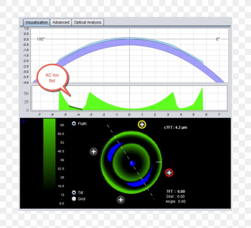 Orthokeratology Near-sightedness Cornea Optometry Astigmatism, PNG, 1200x1094px, Orthokeratology, Astigmatism, Brand, Computer Program, Cornea Download Free