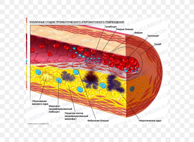 Atheroma Atherosclerosis Artery Stenosis Disease, PNG, 600x600px, Watercolor, Cartoon, Flower, Frame, Heart Download Free