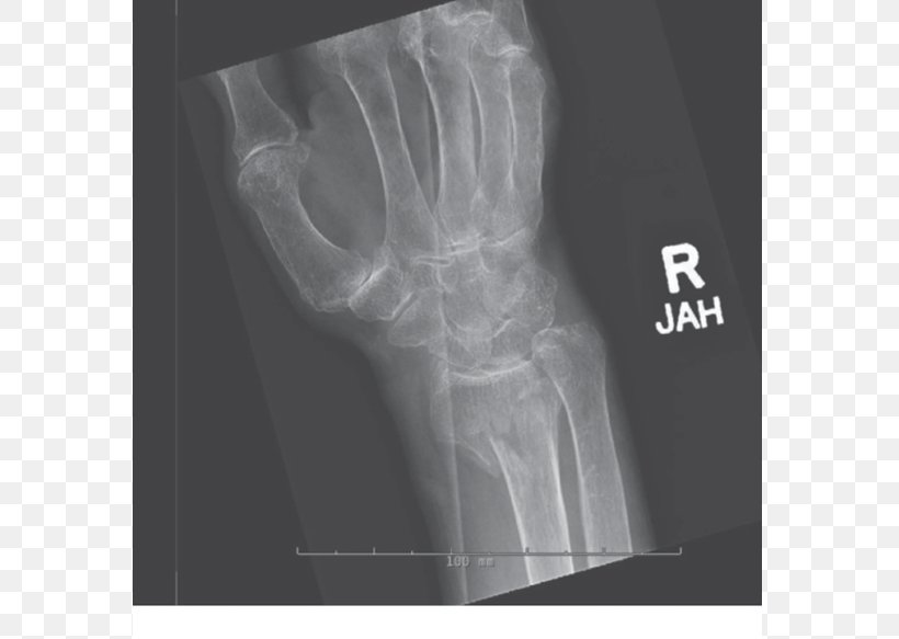 X-ray Bone Fracture Distal Radius Fracture Shoulder Arm, PNG, 709x583px, Xray, Arm, Black And White, Bone, Bone Fracture Download Free